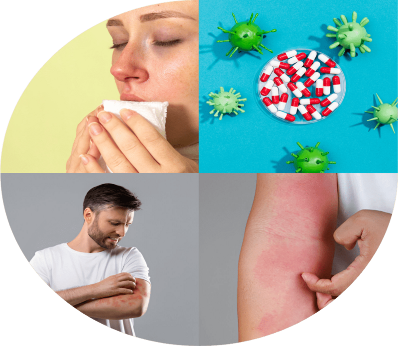 Allergy